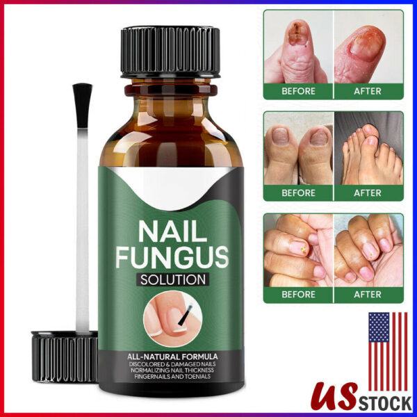 Anti Fungal Nail Treatment Nail Finger Toe Fungus Onychomycosis Remover - Image 3