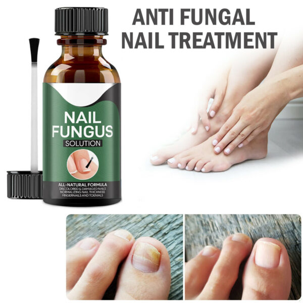 Anti Fungal Nail Treatment Nail Finger Toe Fungus Onychomycosis Remover - Image 5