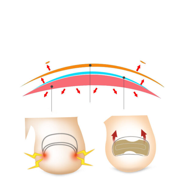 Glue-free orthopaedic nail fixation device - Image 2