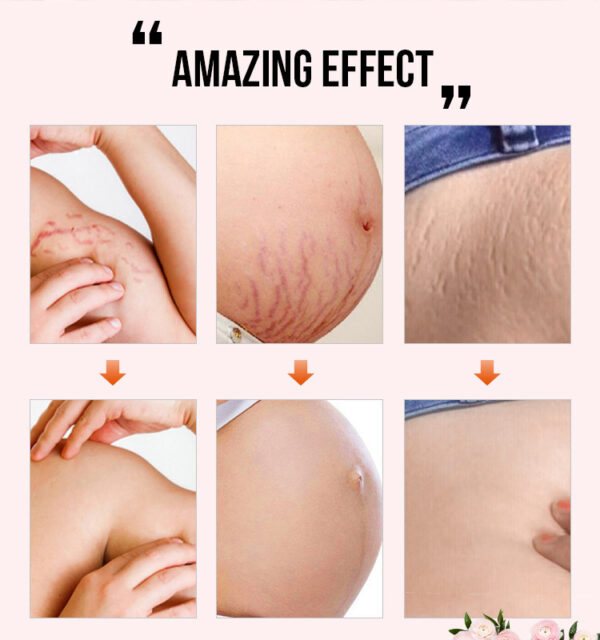 Reduce Postpartum Obesity And Stretch Marks Repair Essential Oil - Image 4