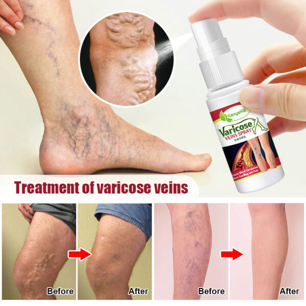 Vein Spray Earthworm Leg Vascular Fluid - Image 6