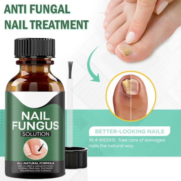 Anti Fungal Nail Treatment Nail Finger Toe Fungus Onychomycosis Remover - Image 10